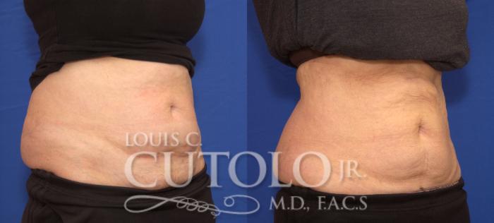 Before & After CoolSculpting® Case 30 View #4 View in Brooklyn, Staten Island, Queens, NY
