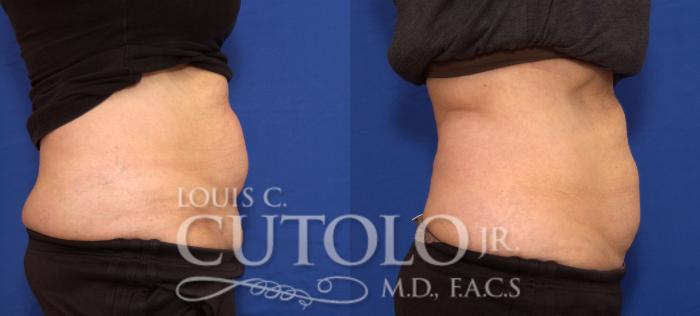 Before & After CoolSculpting® Case 30 View #5 View in Brooklyn, Staten Island, Queens, NY