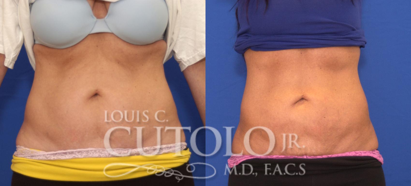 Before & After CoolSculpting® Case 36 View #1 View in Brooklyn, Staten Island, Queens, NY