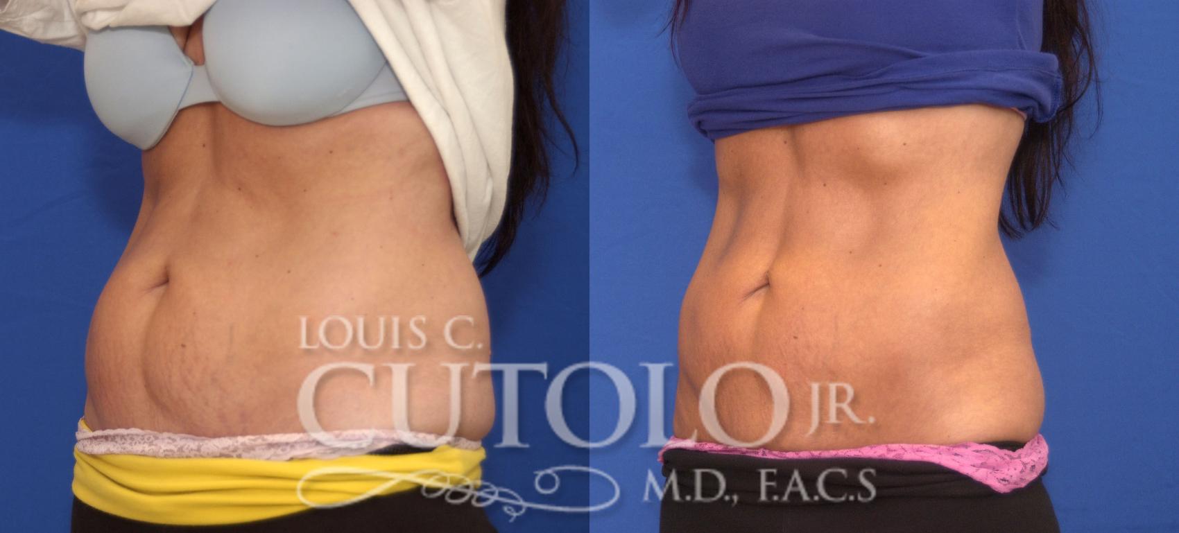 Before & After CoolSculpting® Case 36 View #2 View in Brooklyn, Staten Island, Queens, NY