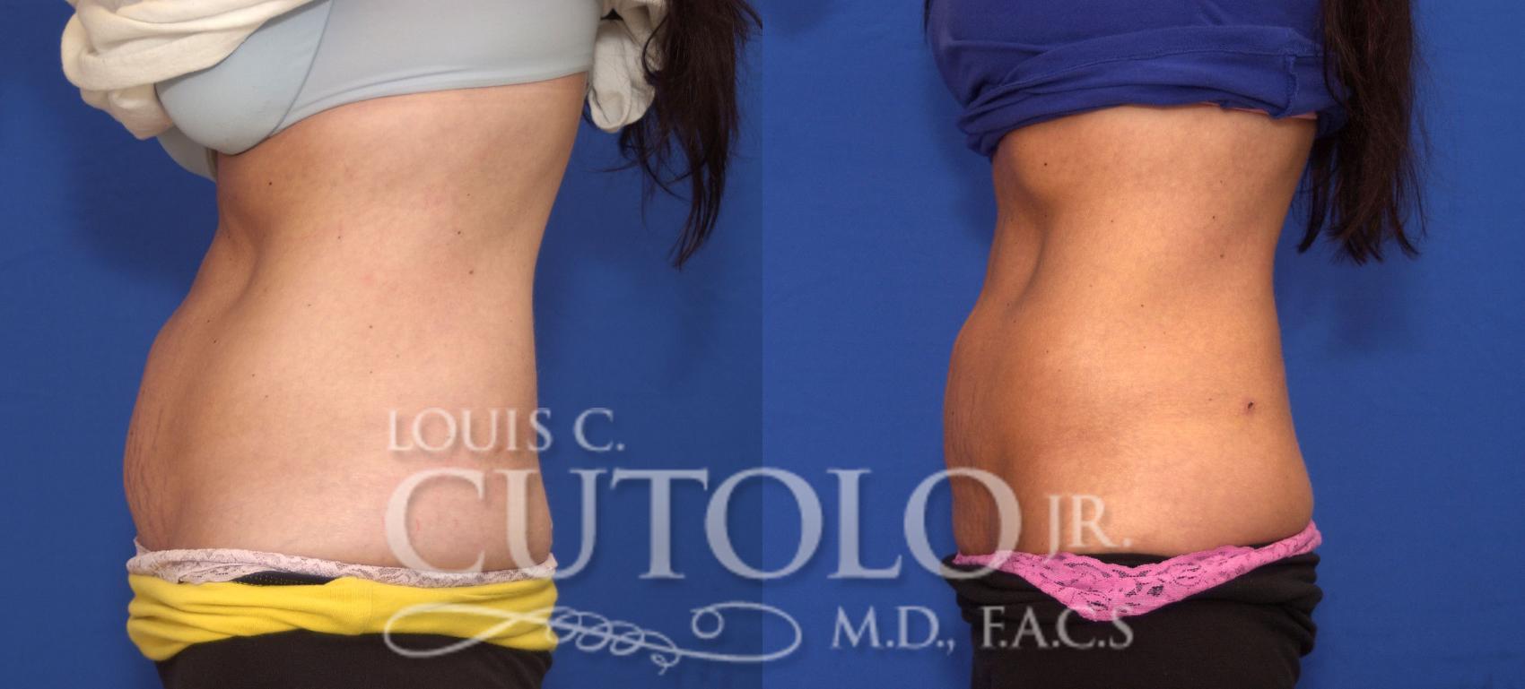 Before & After CoolSculpting® Case 36 View #3 View in Brooklyn, Staten Island, Queens, NY