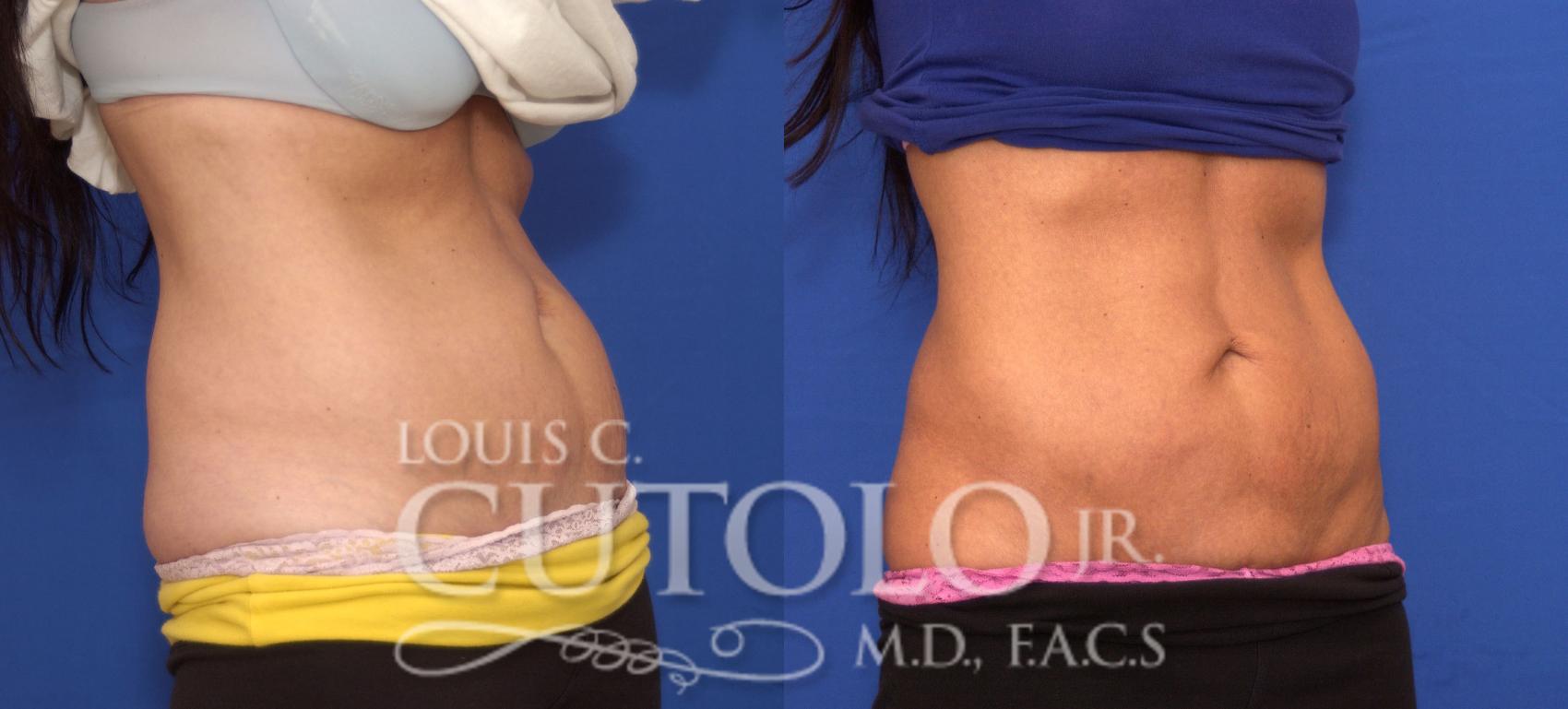 Before & After CoolSculpting® Case 36 View #4 View in Brooklyn, Staten Island, Queens, NY