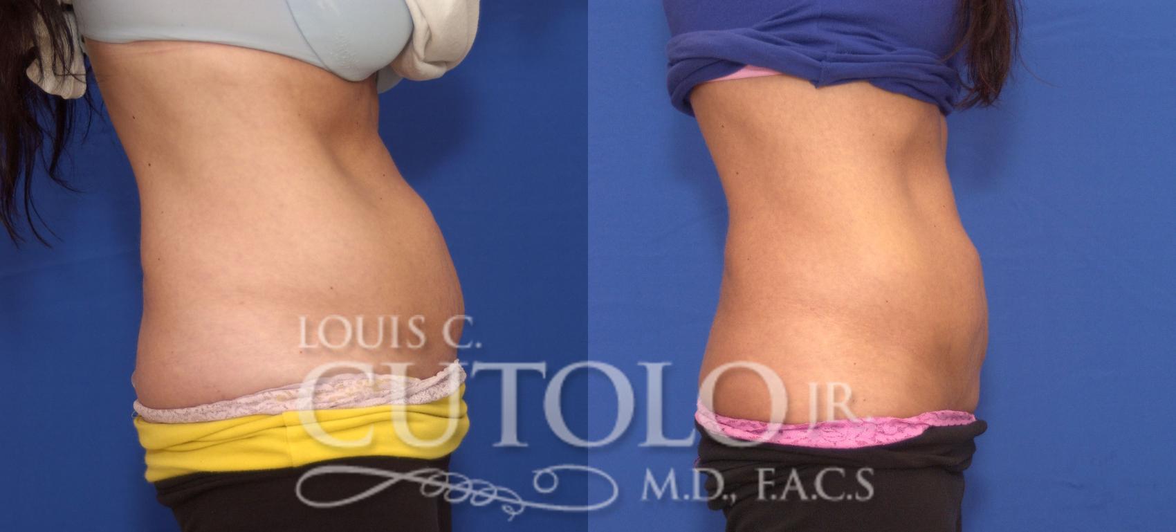 Before & After CoolSculpting® Case 36 View #5 View in Brooklyn, Staten Island, Queens, NY