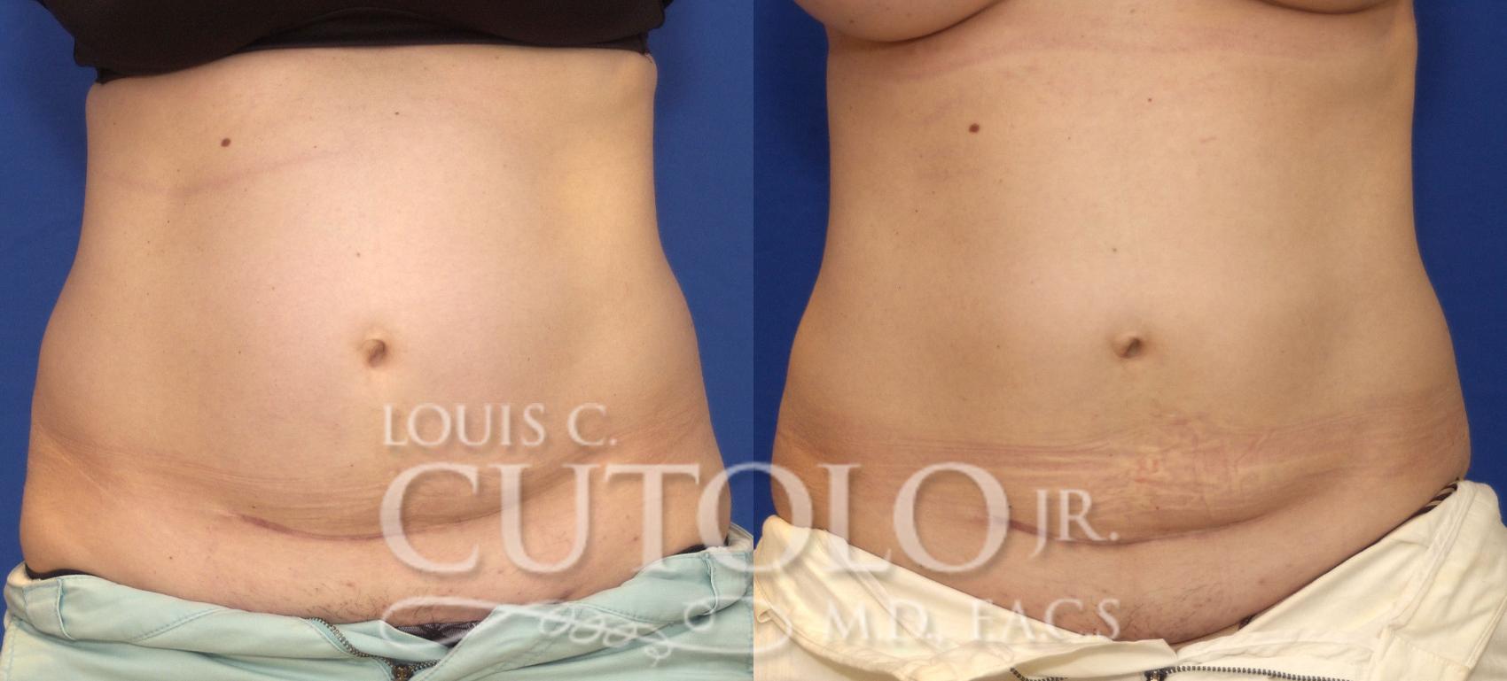 Before & After CoolSculpting® Case 41 View #1 View in Brooklyn, Staten Island, Queens, NY