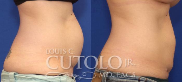 Before & After CoolSculpting® Case 41 View #10 View in Brooklyn, Staten Island, Queens, NY