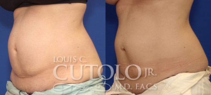 Before & After CoolSculpting® Case 41 View #2 View in Brooklyn, Staten Island, Queens, NY