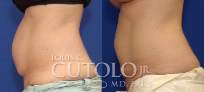Before & After CoolSculpting® Case 41 View #3 View in Brooklyn, Staten Island, Queens, NY