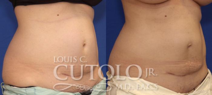 Before & After CoolSculpting® Case 41 View #4 View in Brooklyn, Staten Island, Queens, NY