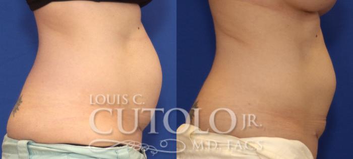 Before & After CoolSculpting® Case 41 View #5 View in Brooklyn, Staten Island, Queens, NY