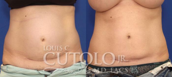 Before & After CoolSculpting® Case 41 View #6 View in Brooklyn, Staten Island, Queens, NY