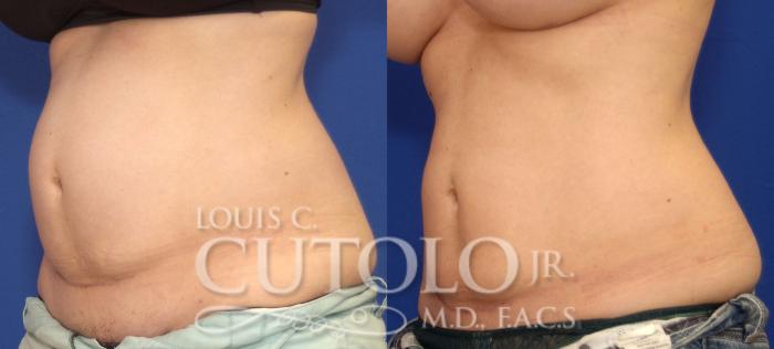 Before & After CoolSculpting® Case 41 View #7 View in Brooklyn, Staten Island, Queens, NY