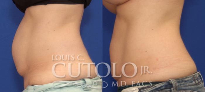 Before & After CoolSculpting® Case 41 View #8 View in Brooklyn, Staten Island, Queens, NY
