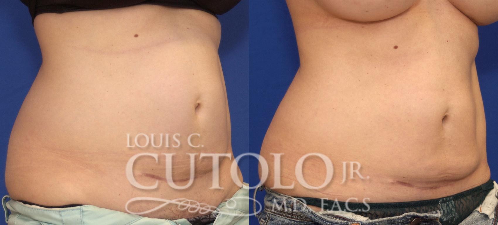 Before & After CoolSculpting® Case 41 View #9 View in Brooklyn, Staten Island, Queens, NY