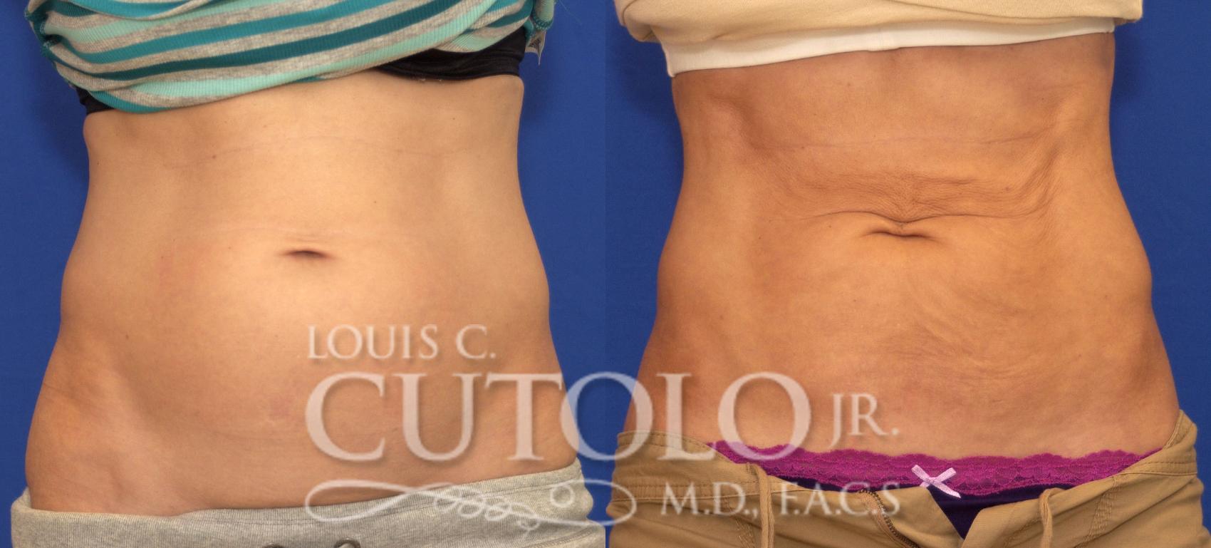 Before & After CoolSculpting® Case 52 View #1 View in Brooklyn, Staten Island, Queens, NY
