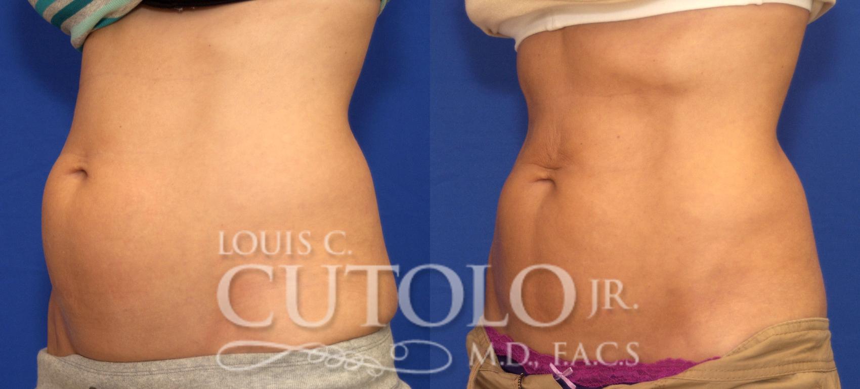 Before & After CoolSculpting® Case 52 View #2 View in Brooklyn, Staten Island, Queens, NY