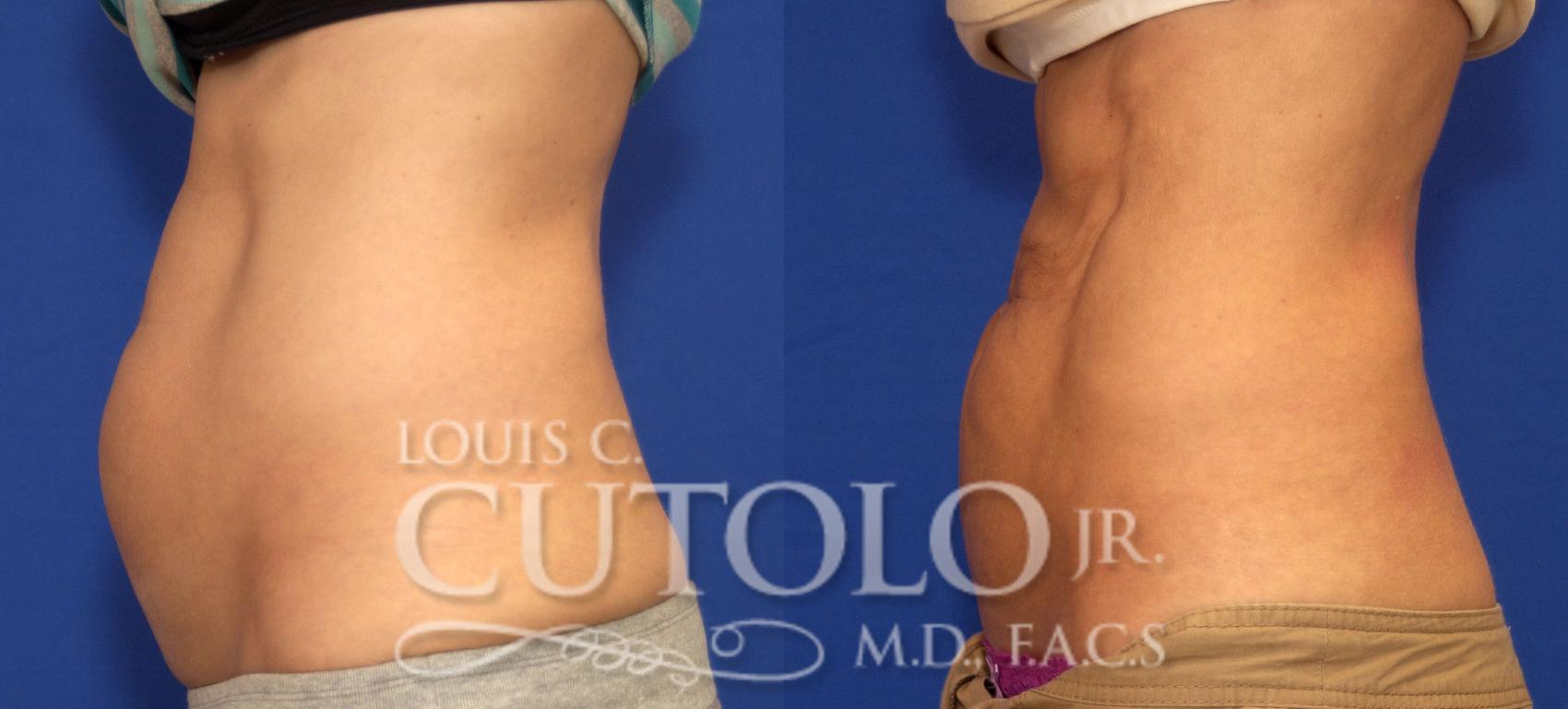 Before & After CoolSculpting® Case 52 View #3 View in Brooklyn, Staten Island, Queens, NY