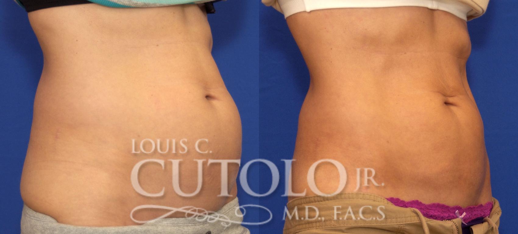 Before & After CoolSculpting® Case 52 View #4 View in Brooklyn, Staten Island, Queens, NY