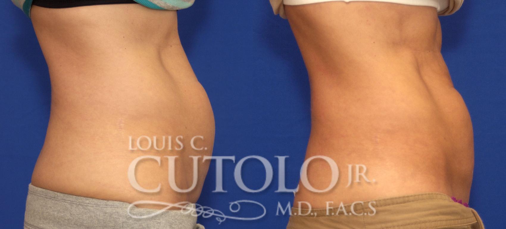 Before & After CoolSculpting® Case 52 View #5 View in Brooklyn, Staten Island, Queens, NY