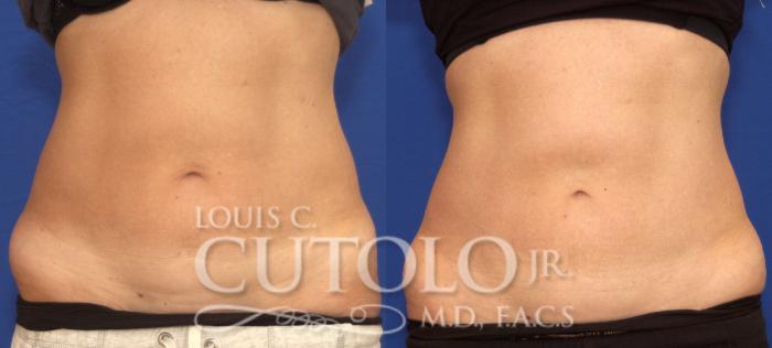 Before & After CoolSculpting® Case 61 View #1 View in Brooklyn, Staten Island, Queens, NY