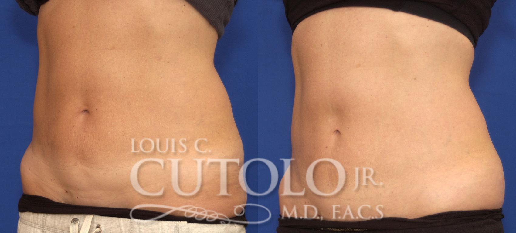 Before & After CoolSculpting® Case 61 View #2 View in Brooklyn, Staten Island, Queens, NY