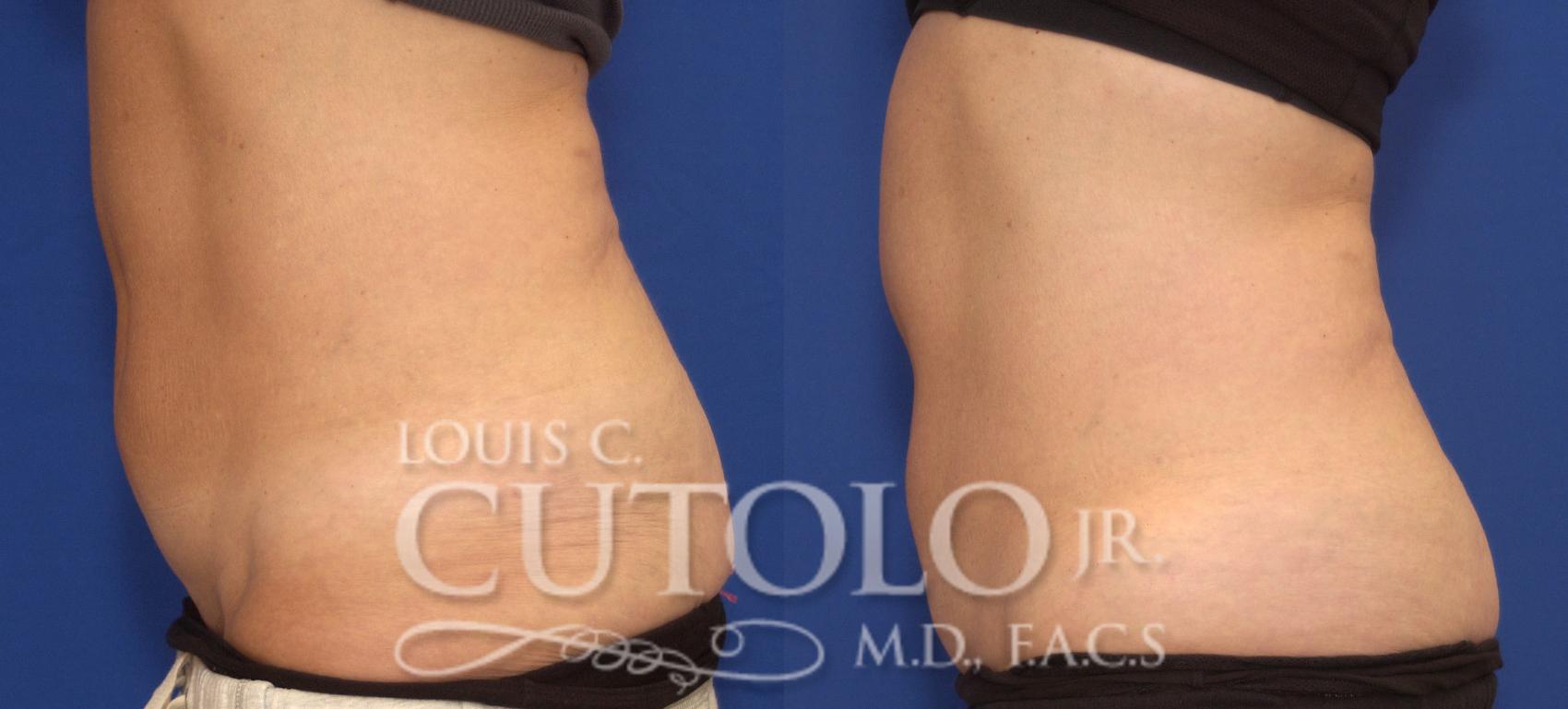 Before & After CoolSculpting® Case 61 View #3 View in Brooklyn, Staten Island, Queens, NY