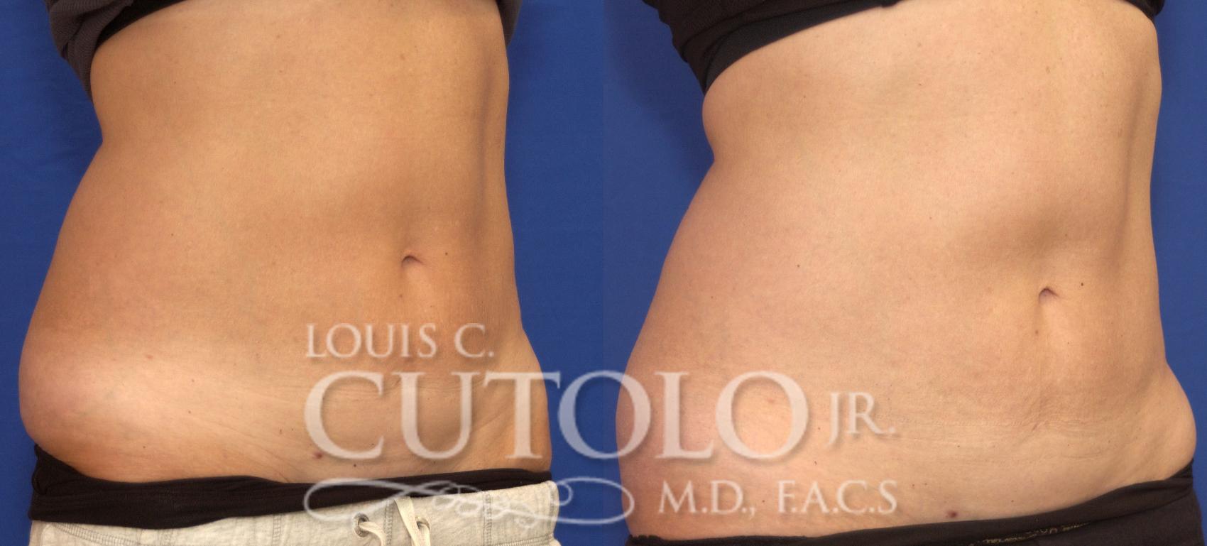 Before & After CoolSculpting® Case 61 View #4 View in Brooklyn, Staten Island, Queens, NY