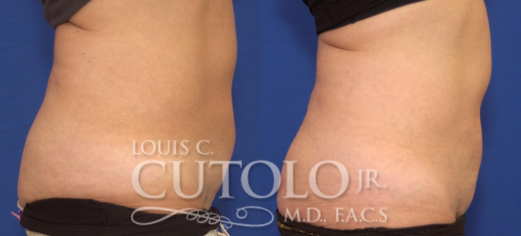 Before & After CoolSculpting® Case 61 View #5 View in Brooklyn, Staten Island, Queens, NY