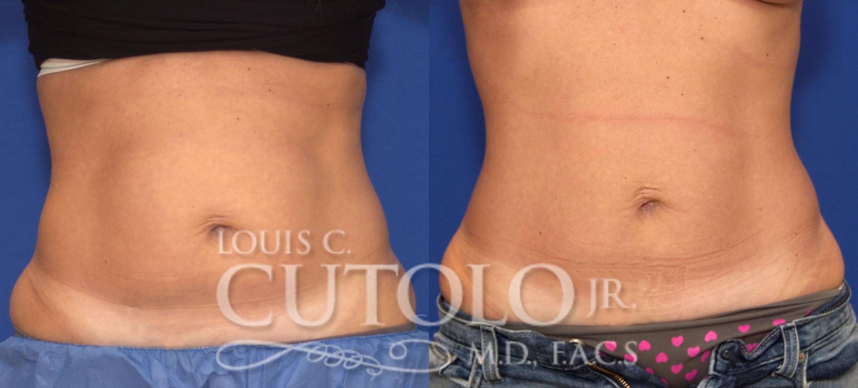 Before & After CoolSculpting® Case 62 View #1 View in Brooklyn, Staten Island, Queens, NY