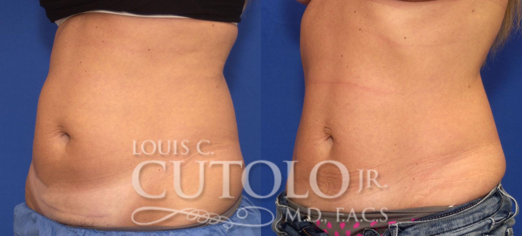 Before & After CoolSculpting® Case 62 View #2 View in Brooklyn, Staten Island, Queens, NY