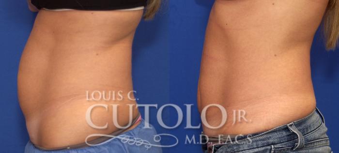 Before & After CoolSculpting® Case 62 View #3 View in Brooklyn, Staten Island, Queens, NY