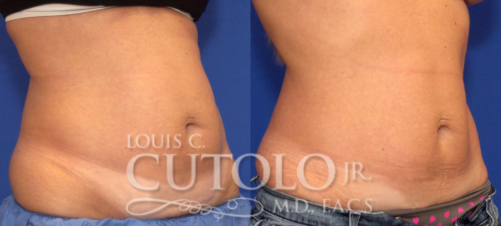 Before & After CoolSculpting® Case 62 View #4 View in Brooklyn, Staten Island, Queens, NY