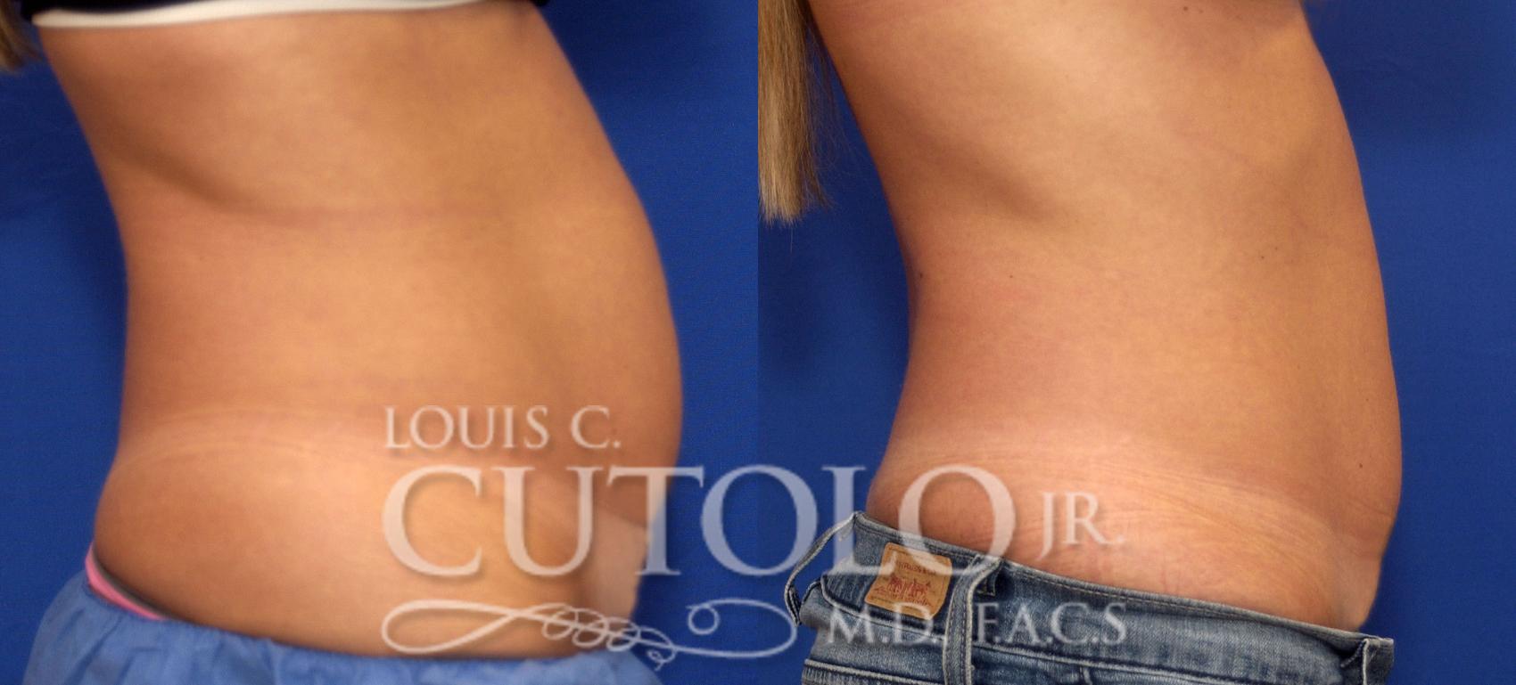 Before & After CoolSculpting® Case 62 View #5 View in Brooklyn, Staten Island, Queens, NY