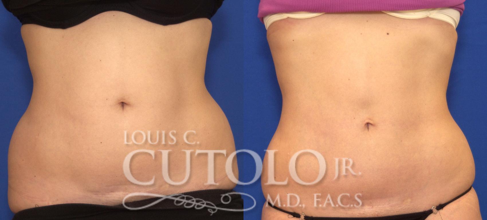 Before & After CoolSculpting® Case 72 View #1 View in Brooklyn, Staten Island, Queens, NY