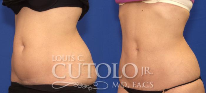 Before & After CoolSculpting® Case 72 View #2 View in Brooklyn, Staten Island, Queens, NY