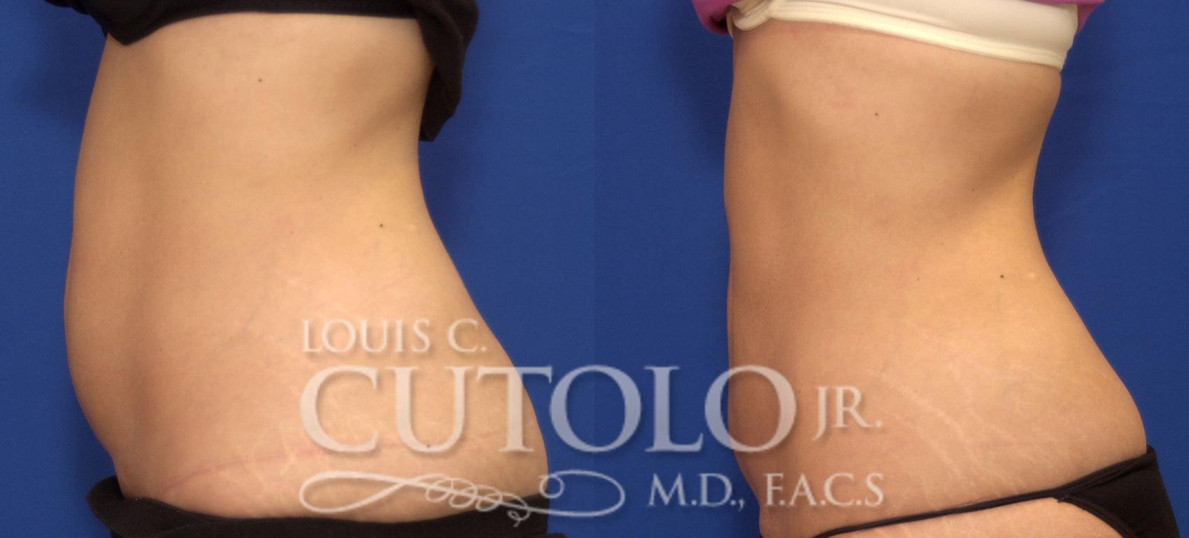 Before & After CoolSculpting® Case 72 View #3 View in Brooklyn, Staten Island, Queens, NY