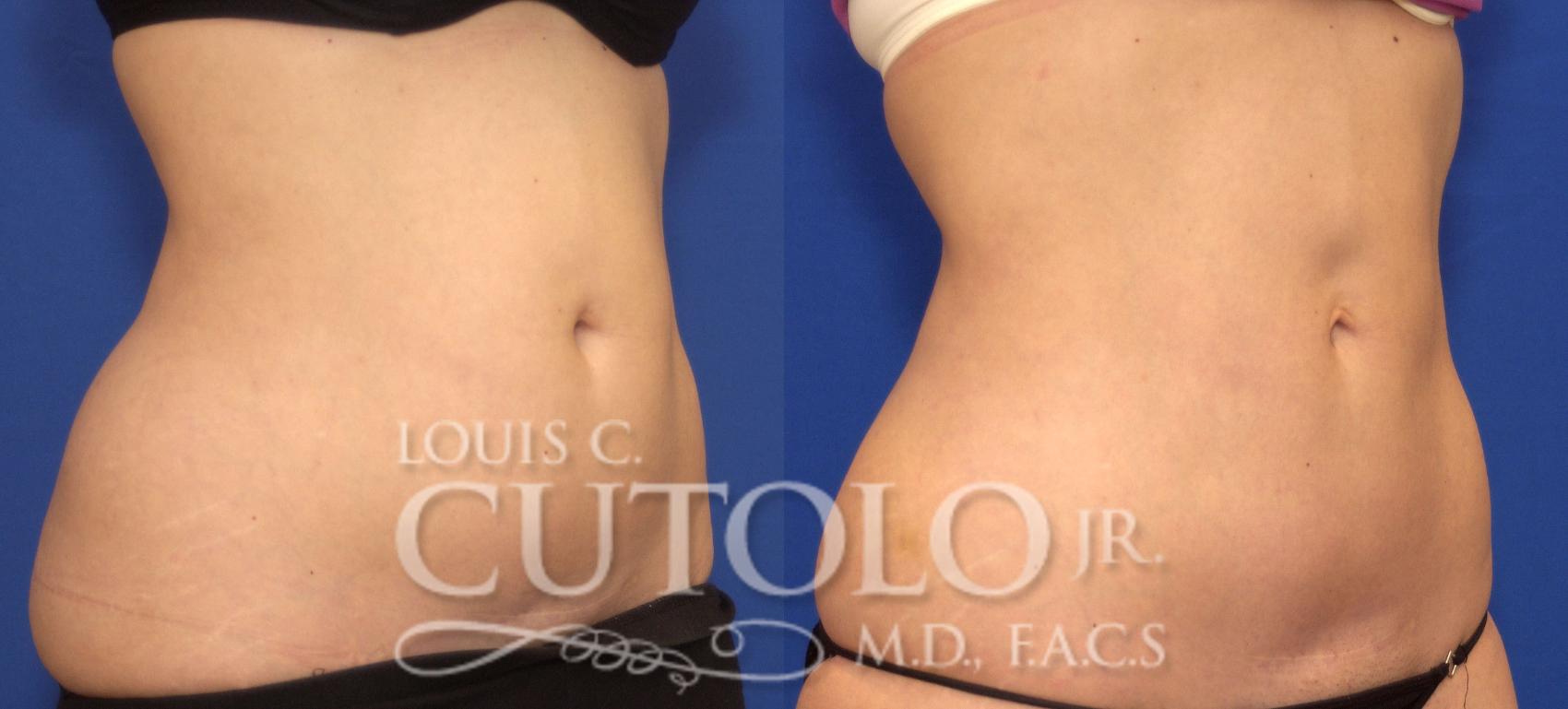 Before & After CoolSculpting® Case 72 View #4 View in Brooklyn, Staten Island, Queens, NY