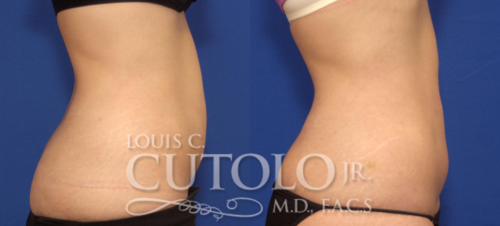 Before & After CoolSculpting® Case 72 View #5 View in Brooklyn, Staten Island, Queens, NY