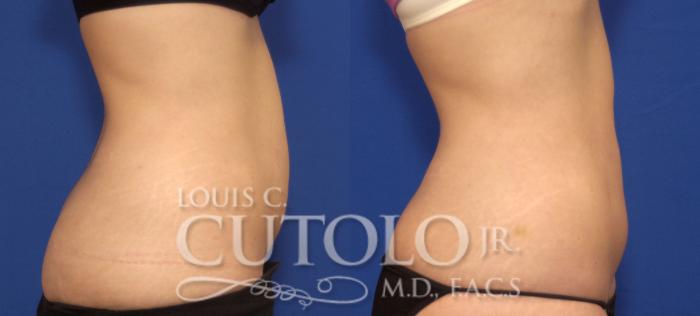 Before & After CoolSculpting® Case 72 View #5 View in Brooklyn, Staten Island, Queens, NY