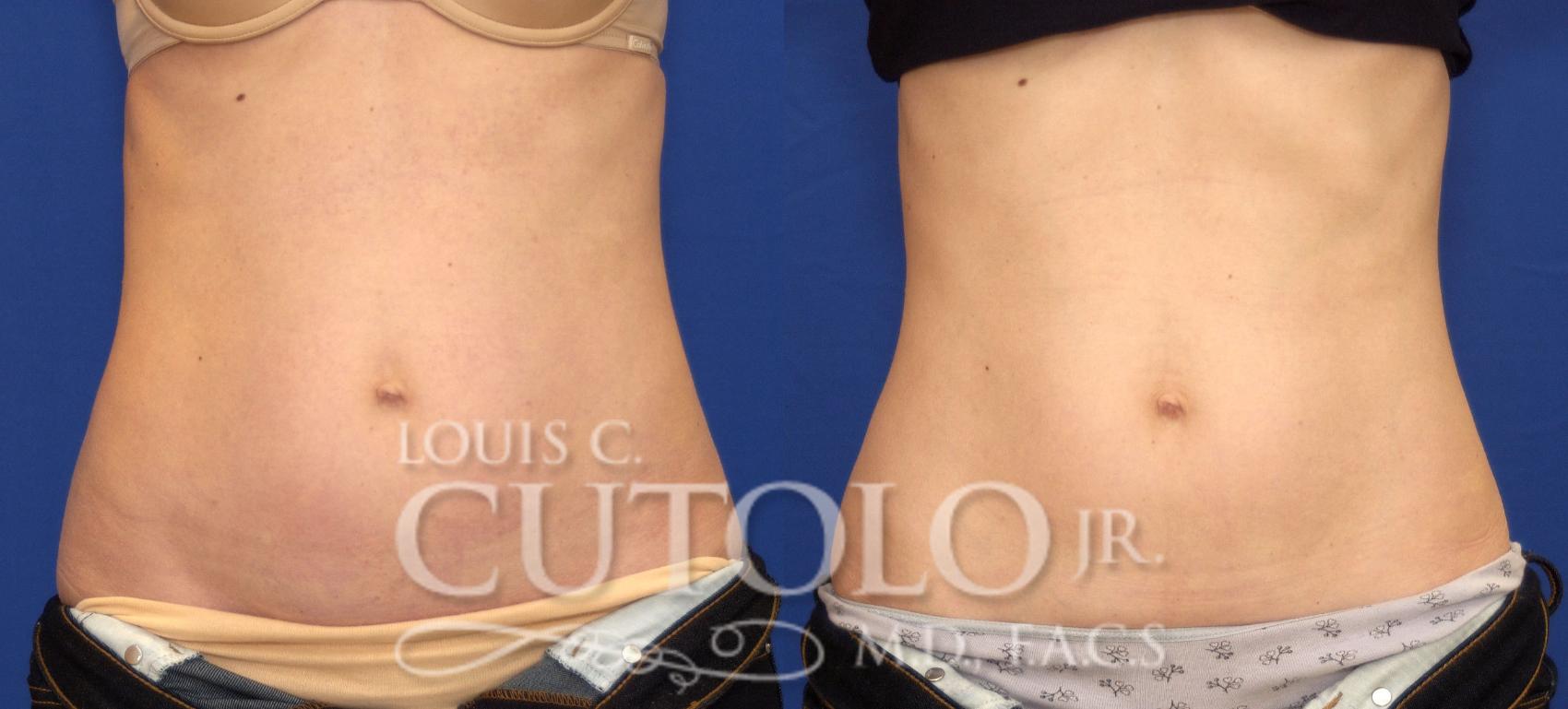 Before & After CoolSculpting® Case 76 View #1 View in Brooklyn, Staten Island, Queens, NY