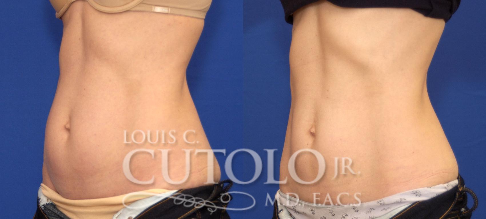 Before & After CoolSculpting® Case 76 View #2 View in Brooklyn, Staten Island, Queens, NY
