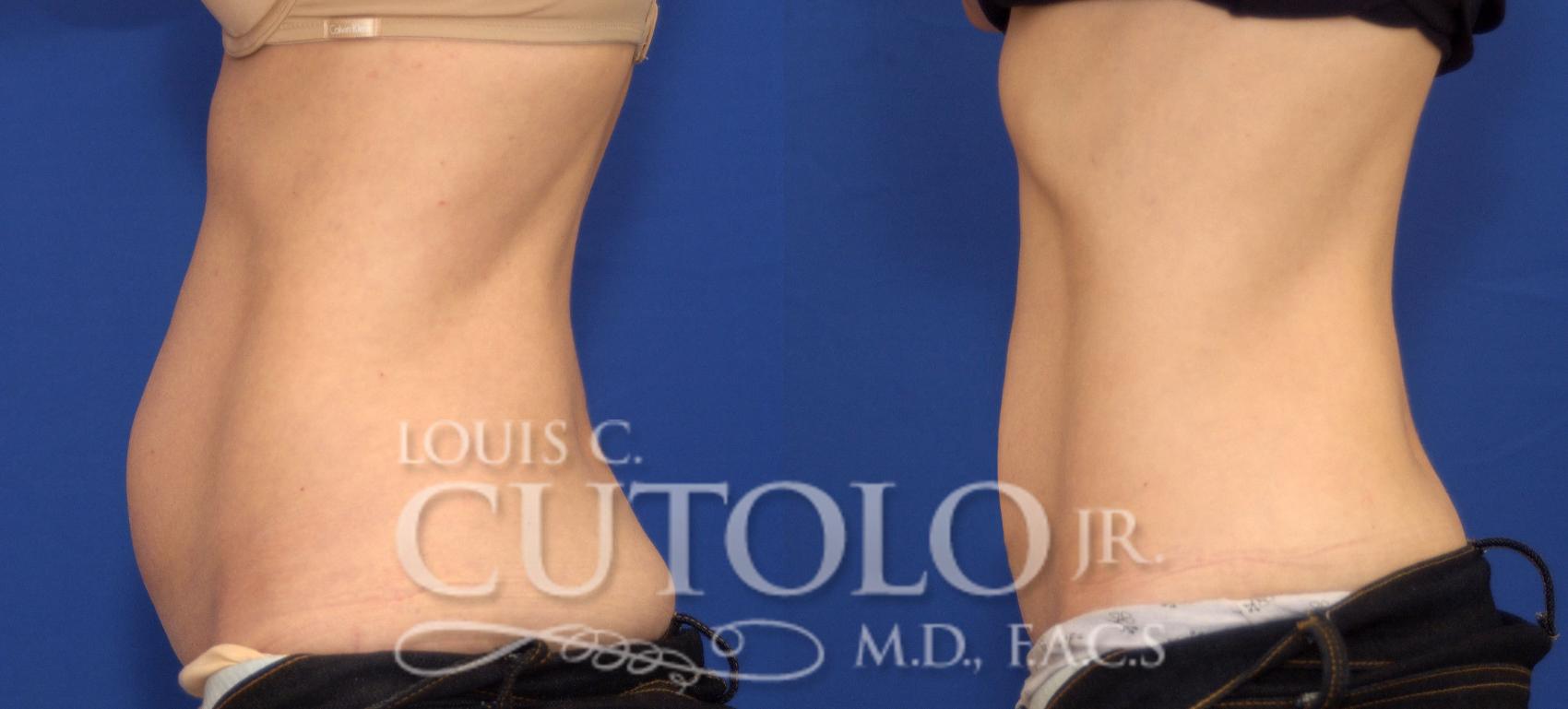 Before & After CoolSculpting® Case 76 View #3 View in Brooklyn, Staten Island, Queens, NY