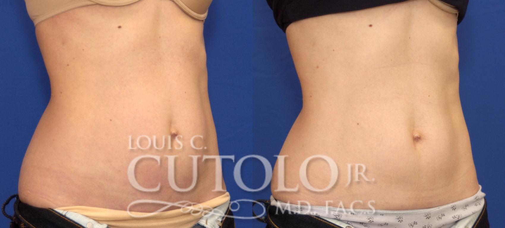 Before & After CoolSculpting® Case 76 View #4 View in Brooklyn, Staten Island, Queens, NY