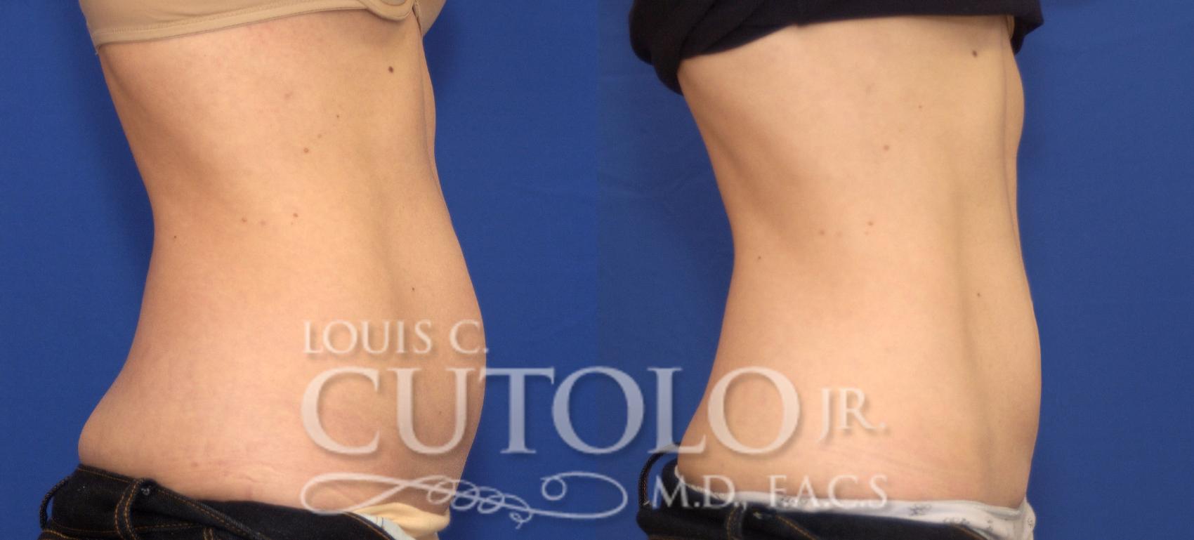 Before & After CoolSculpting® Case 76 View #5 View in Brooklyn, Staten Island, Queens, NY