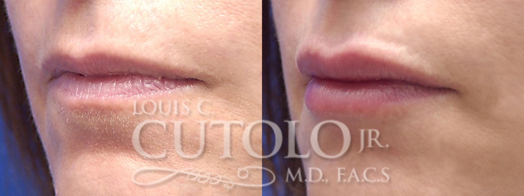 Before & After Dermal Fillers Case 11 View #2 View in Brooklyn, Staten Island, Queens, NY