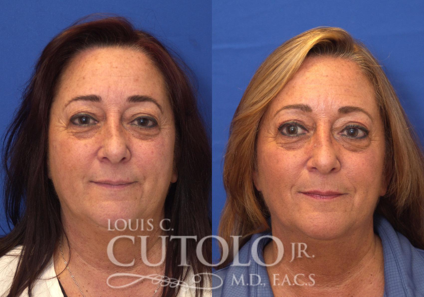 Before & After Eyelid Surgery Case 109 View #1 View in Brooklyn, Staten Island, Queens, NY