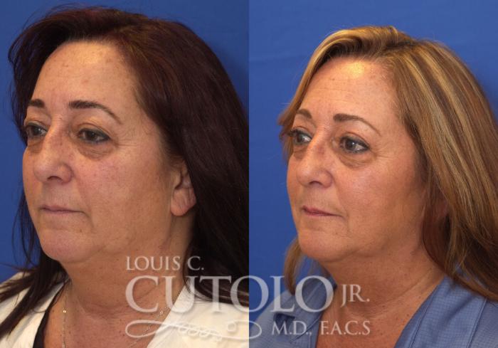 Before & After Eyelid Surgery Case 109 View #2 View in Brooklyn, Staten Island, Queens, NY