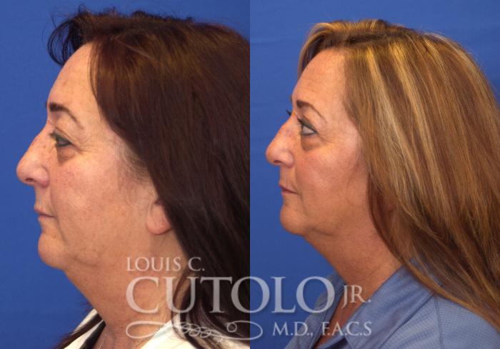 Before & After Eyelid Surgery Case 109 View #3 View in Brooklyn, Staten Island, Queens, NY