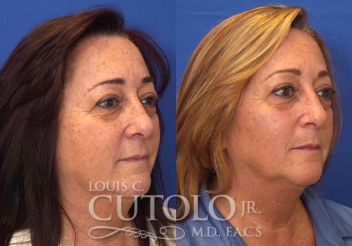 Before & After Eyelid Surgery Case 109 View #4 View in Brooklyn, Staten Island, Queens, NY