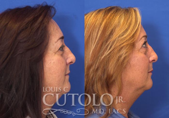 Before & After Eyelid Surgery Case 109 View #5 View in Brooklyn, Staten Island, Queens, NY