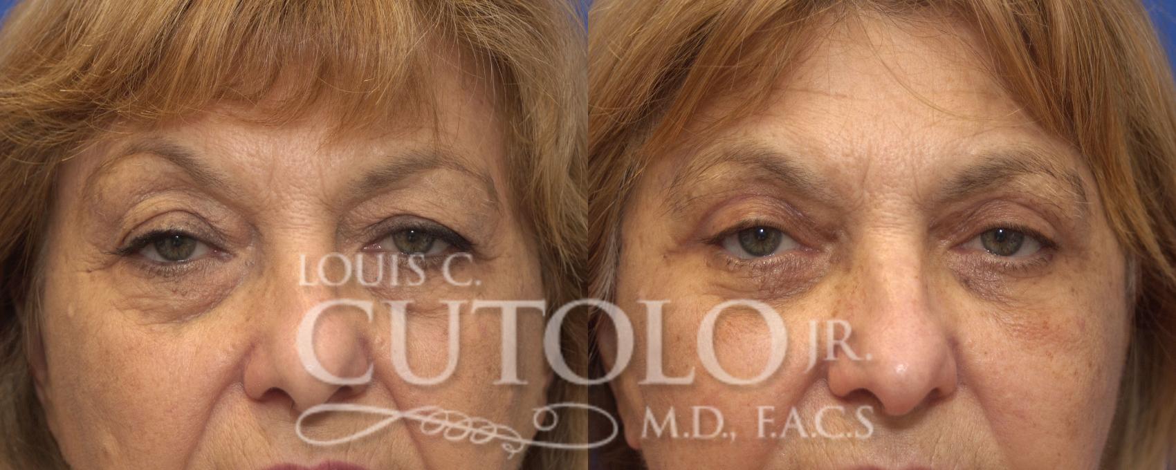 Before & After Eyelid Surgery Case 128 View #1 View in Brooklyn, Staten Island, Queens, NY